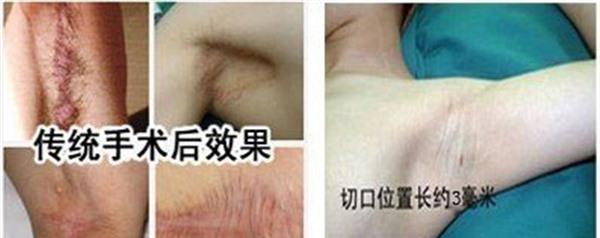 冷凍<a href=http://m.f3bb6.cn/listinfo-784-0.html target=_blank class=infotextkey>去狐臭</a>麻醉方式是什么？