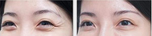 做<a href=http://m.f3bb6.cn/listinfo-734-0.html target=_blank class=infotextkey>愛貝芙</a><a href=http://m.f3bb6.cn/listinfo-782-0.html target=_blank class=infotextkey>去眼角細紋</a>不適應人群有哪些