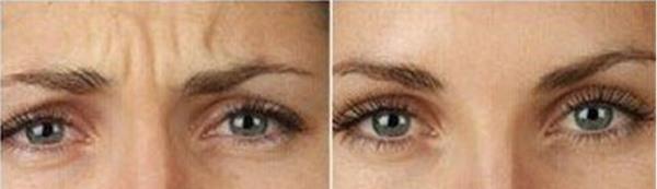 做<a href=http://m.f3bb6.cn/listinfo-734-0.html target=_blank class=infotextkey>愛貝芙</a><a href=http://m.f3bb6.cn/listinfo-771-0.html target=_blank class=infotextkey>去眉間紋</a>風險有哪些