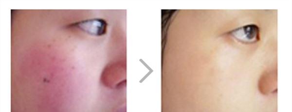 做光子祛紅血絲效果好不好