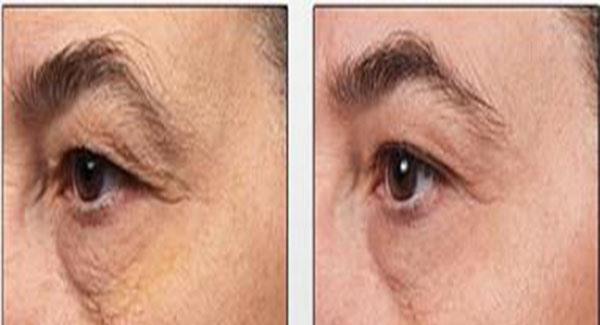 做激光<a href=http://m.f3bb6.cn/listinfo-782-0.html target=_blank class=infotextkey>去眼角細紋</a>副作用