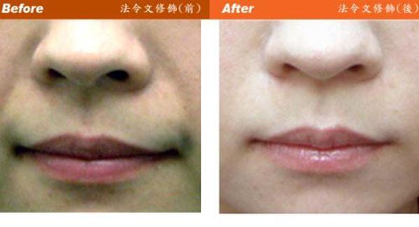做<a href=http://m.f3bb6.cn/listinfo-792-0.html target=_blank class=infotextkey>去法令紋</a>失敗修復副作用
