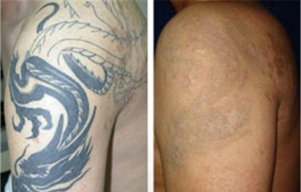 做激光<a href=http://m.f3bb6.cn/listinfo-793-0.html target=_blank class=infotextkey>洗紋身</a>副作用是什么