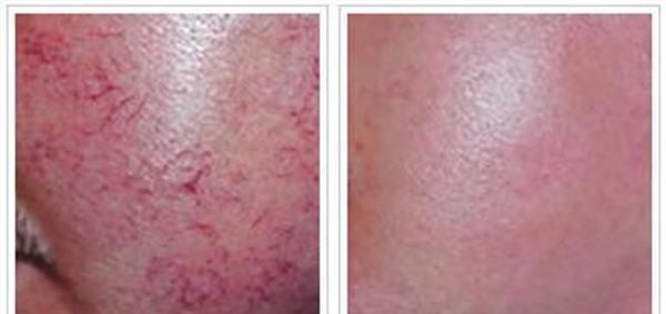 做<a href=http://m.f3bb6.cn/listinfo-772-0.html target=_blank class=infotextkey>去紅血絲</a>失敗修復效果好不好