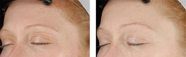 做內窺鏡<a href=http://m.f3bb6.cn/listinfo-614-0.html target=_blank class=infotextkey>除皺</a><a href=http://m.f3bb6.cn/listinfo-765-0.html target=_blank class=infotextkey>去抬頭紋</a>效果好不好