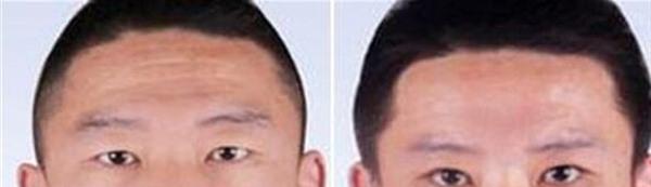 <a href=http://m.f3bb6.cn/listinfo-731-0.html target=_blank class=infotextkey>玻尿酸</a><a href=http://m.f3bb6.cn/listinfo-771-0.html target=_blank class=infotextkey>去眉間紋</a>需要怎么護理？