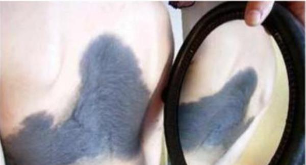 做光子治療太田痣價格貴嗎