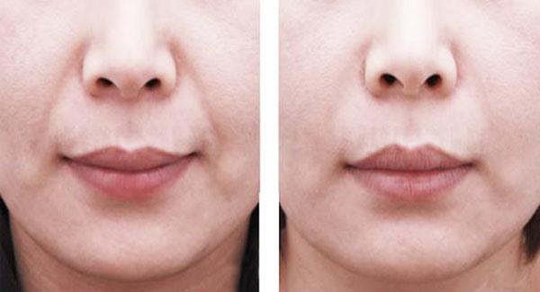 做<a href=http://m.f3bb6.cn/listinfo-792-0.html target=_blank class=infotextkey>去法令紋</a>價(jià)格貴嗎