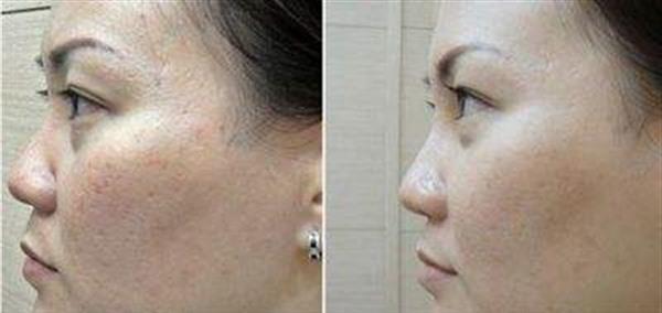 做自體脂肪<a href=http://m.f3bb6.cn/listinfo-797-0.html target=_blank class=infotextkey>去痘疤</a>費用大概需要多少