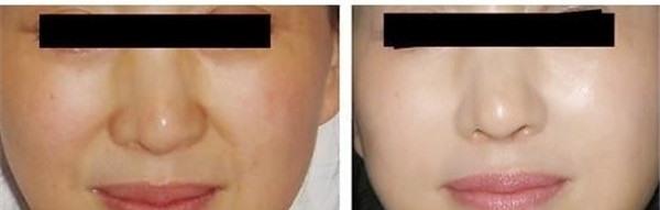 做<a href=http://m.f3bb6.cn/listinfo-613-0.html target=_blank class=infotextkey>射頻</a><a href=http://m.f3bb6.cn/listinfo-792-0.html target=_blank class=infotextkey>去法令紋</a>價格