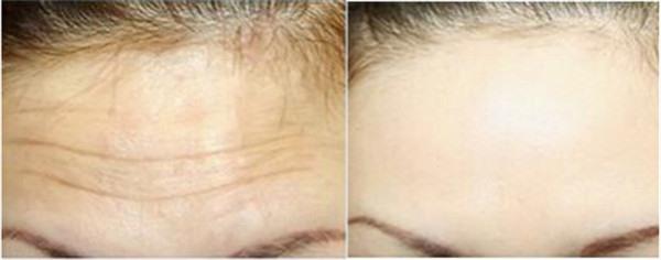 做<a href=http://m.f3bb6.cn/listinfo-765-0.html target=_blank class=infotextkey>去抬頭紋</a>失敗修復價格