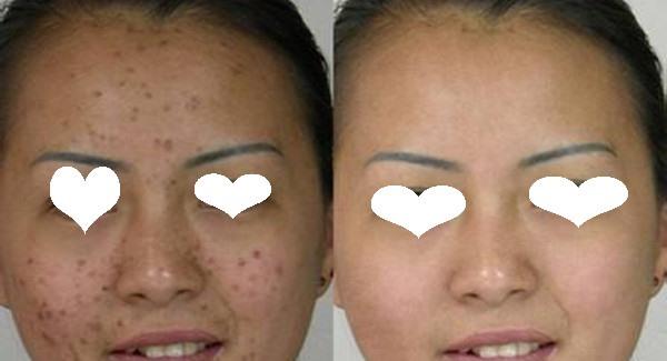 做脈沖光去痘印價格是多少