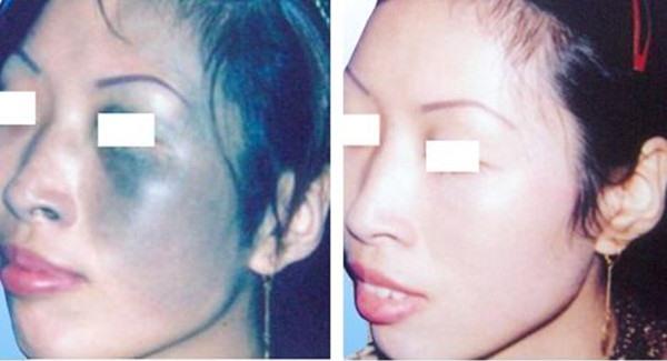 做光子治療太田痣價(jià)格是多少