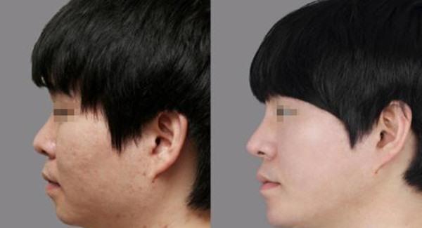 做激光<a href=http://m.f3bb6.cn/listinfo-797-0.html target=_blank class=infotextkey>去痘疤</a>手術時間是多久？