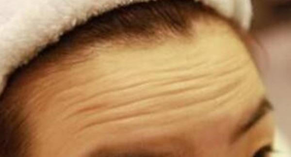 做微晶磨削<a href=http://m.f3bb6.cn/listinfo-765-0.html target=_blank class=infotextkey>去抬頭紋</a>手術注意事項是什么？