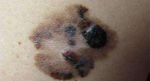 做激光點痣手術注意事項是什么？