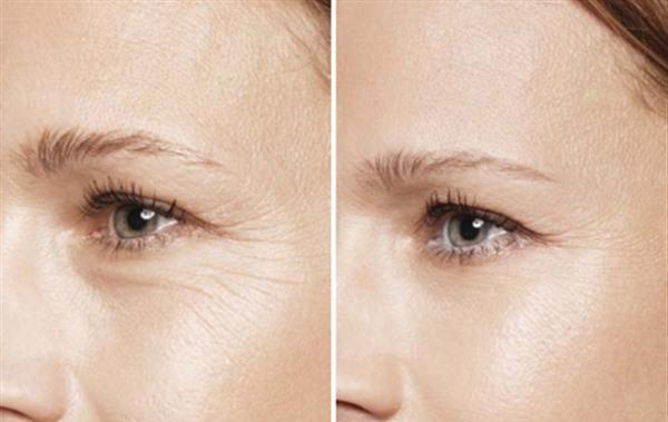 額顳部<a href=http://m.f3bb6.cn/listinfo-614-0.html target=_blank class=infotextkey>除皺</a><a href=http://m.f3bb6.cn/listinfo-780-0.html target=_blank class=infotextkey>去魚尾紋</a>維持時間是多久？