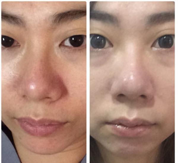 果酸煥膚<a href=http://m.f3bb6.cn/listinfo-781-0.html target=_blank class=infotextkey>祛痘印</a>手術術后護理？