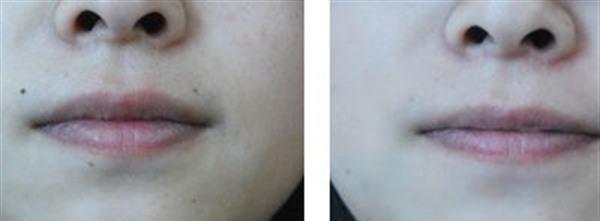 E光點(diǎn)痣手術(shù)安全嗎?