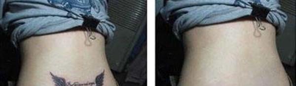 皮膚磨削去紋身手術安全嗎?