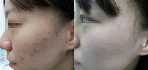 做<a href=http://m.f3bb6.cn/listinfo-613-0.html target=_blank class=infotextkey>射頻</a><a href=http://m.f3bb6.cn/listinfo-768-0.html target=_blank class=infotextkey>微針</a><a href=http://m.f3bb6.cn/listinfo-797-0.html target=_blank class=infotextkey>去痘疤</a>多少錢