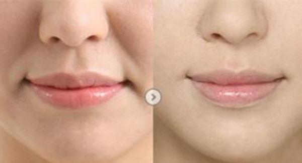 做光子<a href=http://m.f3bb6.cn/listinfo-792-0.html target=_blank class=infotextkey>去法令紋</a>手術(shù)注意事項是什么？