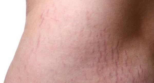 做微晶<a href=http://m.f3bb6.cn/listinfo-791-0.html target=_blank class=infotextkey>去妊娠紋</a>手術注意事項是什么？