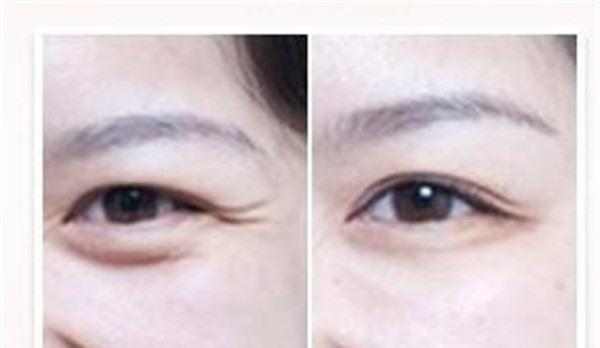 自體脂肪<a href=http://m.f3bb6.cn/listinfo-780-0.html target=_blank class=infotextkey>去魚尾紋</a>要多少錢？