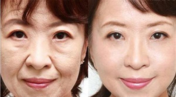 <a href=http://m.f3bb6.cn/listinfo-613-0.html target=_blank class=infotextkey>射頻</a><a href=http://m.f3bb6.cn/listinfo-768-0.html target=_blank class=infotextkey>微針</a><a href=http://m.f3bb6.cn/listinfo-771-0.html target=_blank class=infotextkey>去眉間紋</a>效果怎么樣？