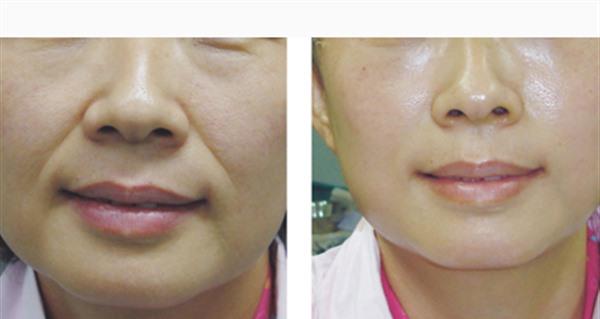 膠原蛋白<a href=http://m.f3bb6.cn/listinfo-792-0.html target=_blank class=infotextkey>去法令紋</a>有副作用嗎？