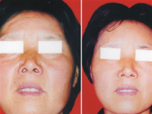 <a href=http://m.f3bb6.cn/listinfo-765-0.html target=_blank class=infotextkey>去抬頭紋</a>失敗修復(fù)需要怎么護理?