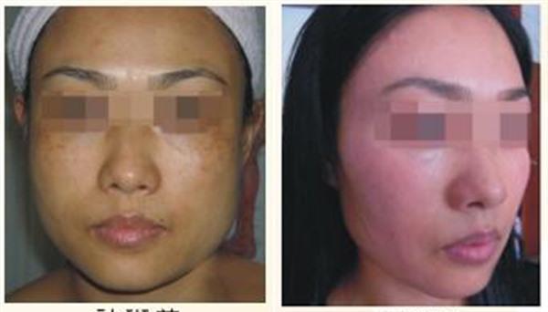 做光子<a href=http://m.f3bb6.cn/listinfo-774-0.html target=_blank class=infotextkey>去雀斑</a>多少錢