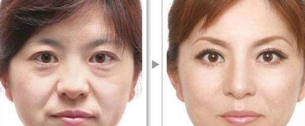 E光<a href=http://m.f3bb6.cn/listinfo-780-0.html target=_blank class=infotextkey>去魚(yú)尾紋</a>效果怎么樣？