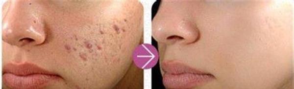 脈沖光去痘印手術注意事項是什么？