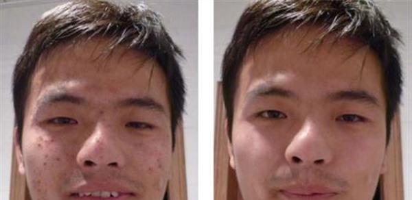 做切開填充治療痘疤手術(shù)多少錢？