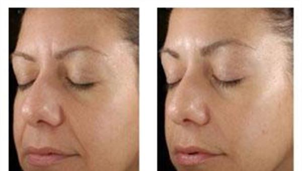 做果酸換膚<a href=http://m.f3bb6.cn/listinfo-782-0.html target=_blank class=infotextkey>去眼角細紋</a>手術多少錢？