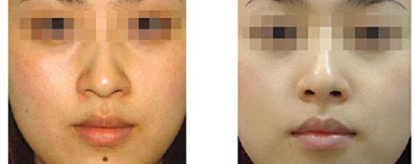 光子<a href=http://m.f3bb6.cn/listinfo-792-0.html target=_blank class=infotextkey>去法令紋</a>手術注意事項是什么？