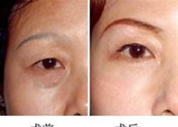 E光<a href=http://m.f3bb6.cn/listinfo-780-0.html target=_blank class=infotextkey>去魚尾紋</a>手術(shù)注意事項是什么？