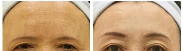 激光去除抬頭紋手術注意事項是什么？