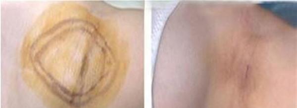 激光<a href=http://m.f3bb6.cn/listinfo-784-0.html target=_blank class=infotextkey>去狐臭</a>手術(shù)注意事項是什么？