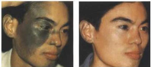 做光子治療太田痣手術多少錢？