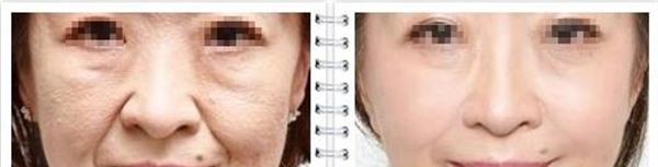 內窺鏡<a href=http://m.f3bb6.cn/listinfo-614-0.html target=_blank class=infotextkey>除皺</a><a href=http://m.f3bb6.cn/listinfo-780-0.html target=_blank class=infotextkey>去魚尾紋</a>手術效果好不好？