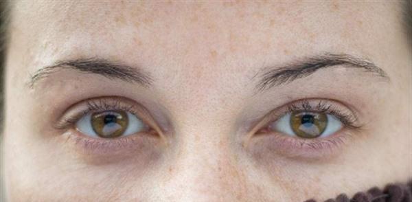 E光祛雀斑的效果怎樣