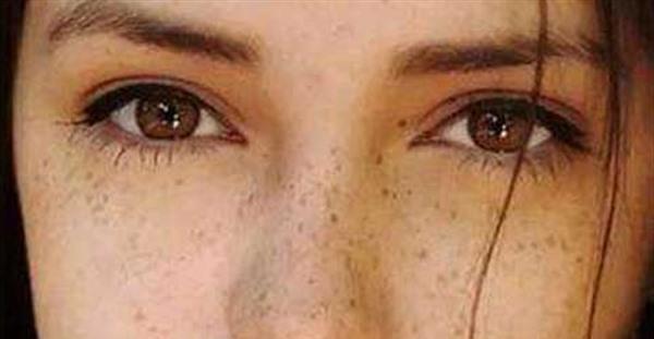 治雀斑最有效的方法