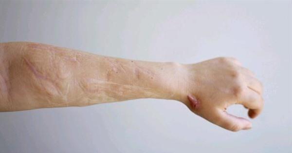 點痣后留疤怎么辦