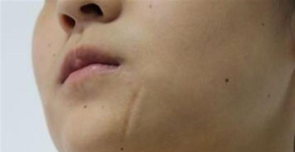 點(diǎn)痣后疤痕怎么辦