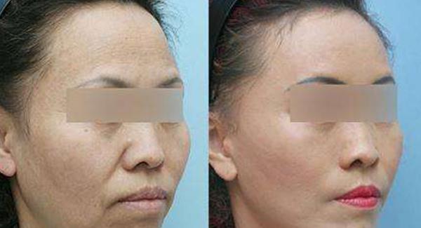 <a href=http://m.f3bb6.cn/listinfo-797-0.html target=_blank class=infotextkey>去痘疤</a>痘坑多少錢