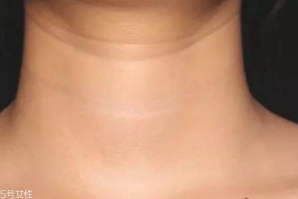 激光<a href=http://m.f3bb6.cn/listinfo-785-0.html target=_blank class=infotextkey>去頸紋</a>有用嗎 <a href=http://m.f3bb6.cn/listinfo-785-0.html target=_blank class=infotextkey>去頸紋</a>還有什么方式