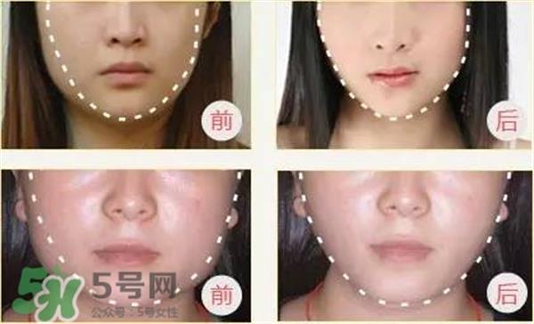 打完<a href=http://m.f3bb6.cn/listinfo-631-0.html target=_blank class=infotextkey>瘦臉</a>針多久可以化妝？打完<a href=http://m.f3bb6.cn/listinfo-631-0.html target=_blank class=infotextkey>瘦臉</a>針的反應(yīng)