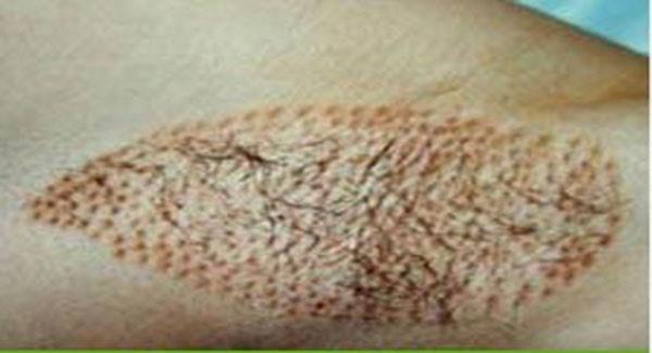 做電離子<a href=http://m.f3bb6.cn/listinfo-766-0.html target=_blank class=infotextkey>去腋臭</a>副作用